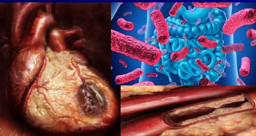 Escherichia e infarto