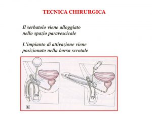 Protesi peniena